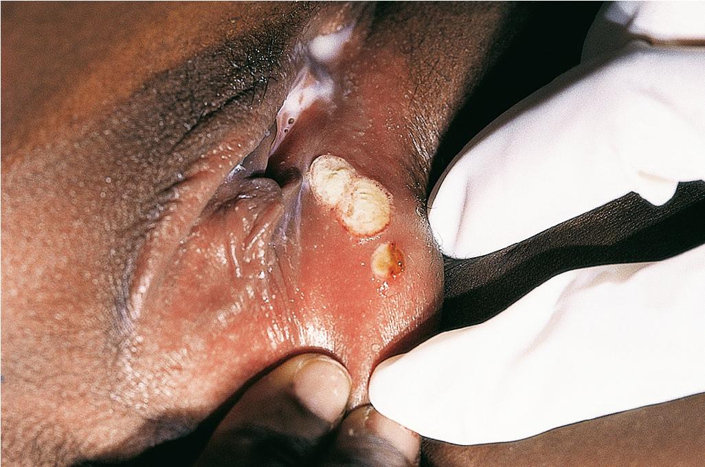 Fig. 25.22, Behçet disease. Vulvar ulcerations.