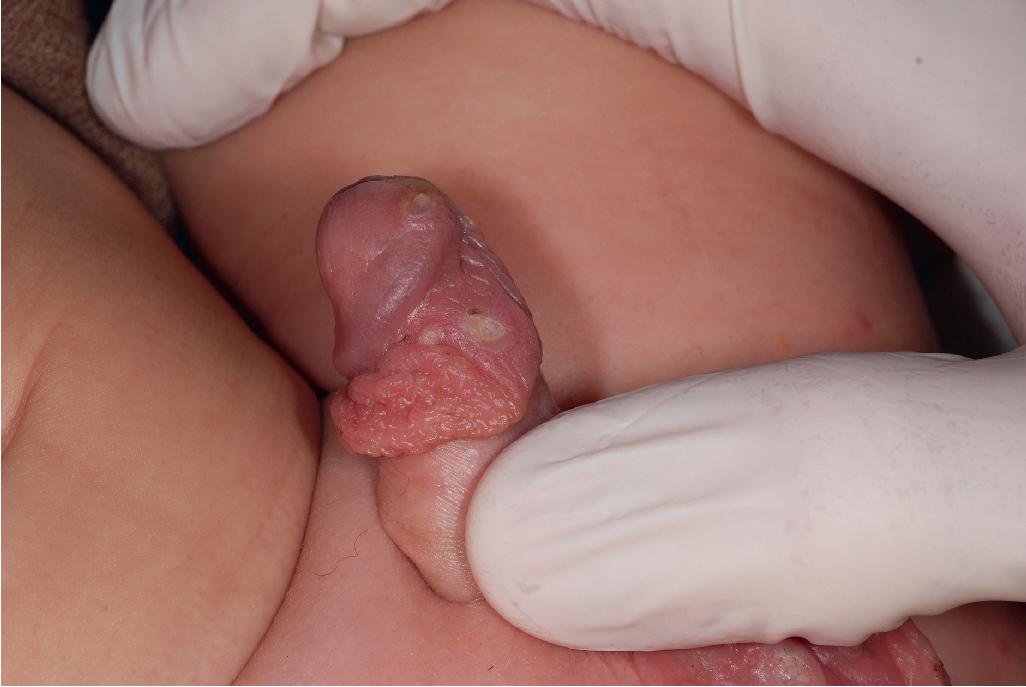 Fig. 25.23, Behçet disease. Genital region ulcers on the glans penis and foreskin in a boy with a positive family history of Behçet disease and HLA-B51 positivity.