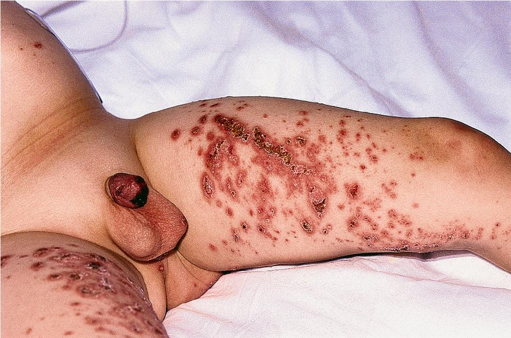 Fig. 25.24, Behçet disease. Palpable purpura on the inner thighs and glans penis of this boy with Behçet disease. Superficial ulcerations were also noted on the penile shaft. Biopsy of affected areas showed leukocytoclastic vasculitis.