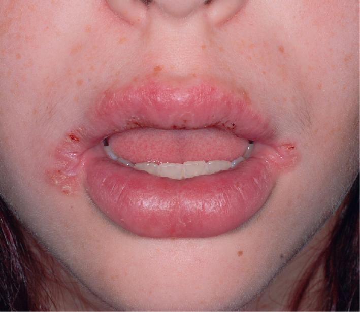 Fig. 25.25, Orofacial granulomatosis. Granulomatous infiltration limited to the lip(s) is called cheilitis granulomatosa.