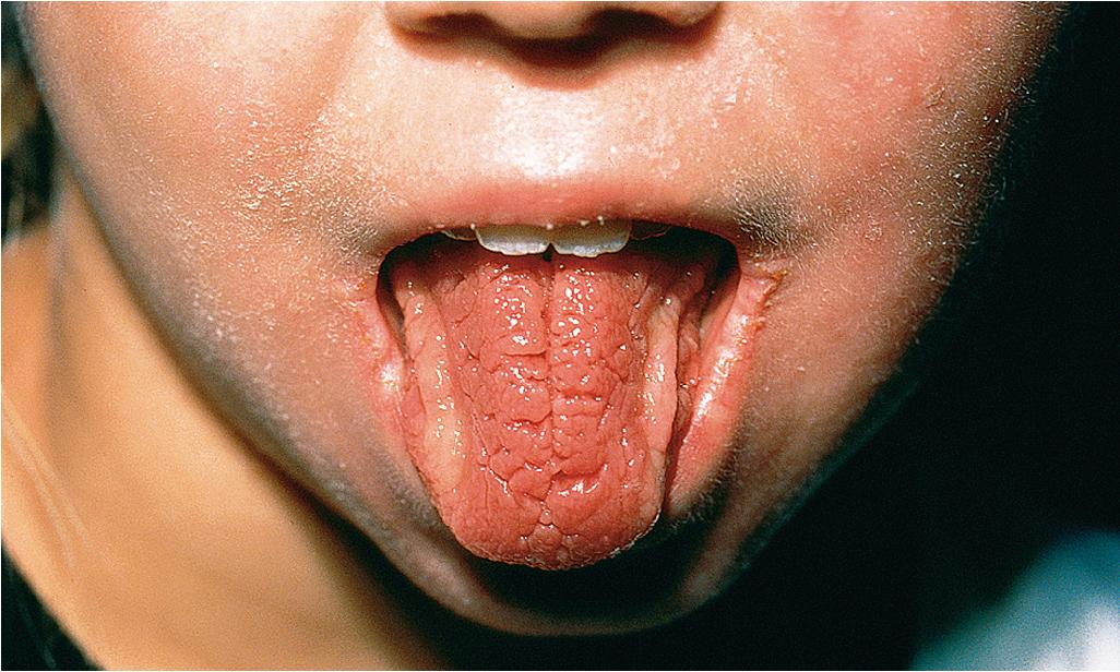 Fig. 25.26, Orofacial granulomatosis as part of Melkersson–Rosenthal syndrome. Scrotal tongue.