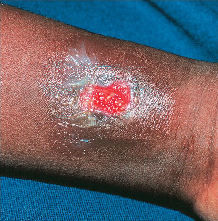 Fig. 25.3, Leukocyte adhesion deficiency. Small wounds can lead to large ulcerations that may resemble pyoderma gangrenosum. The ulceration on this boy’s leg, initiated by a scratch from his sister, eventually extended to several centimeters in diameter and required a graft.