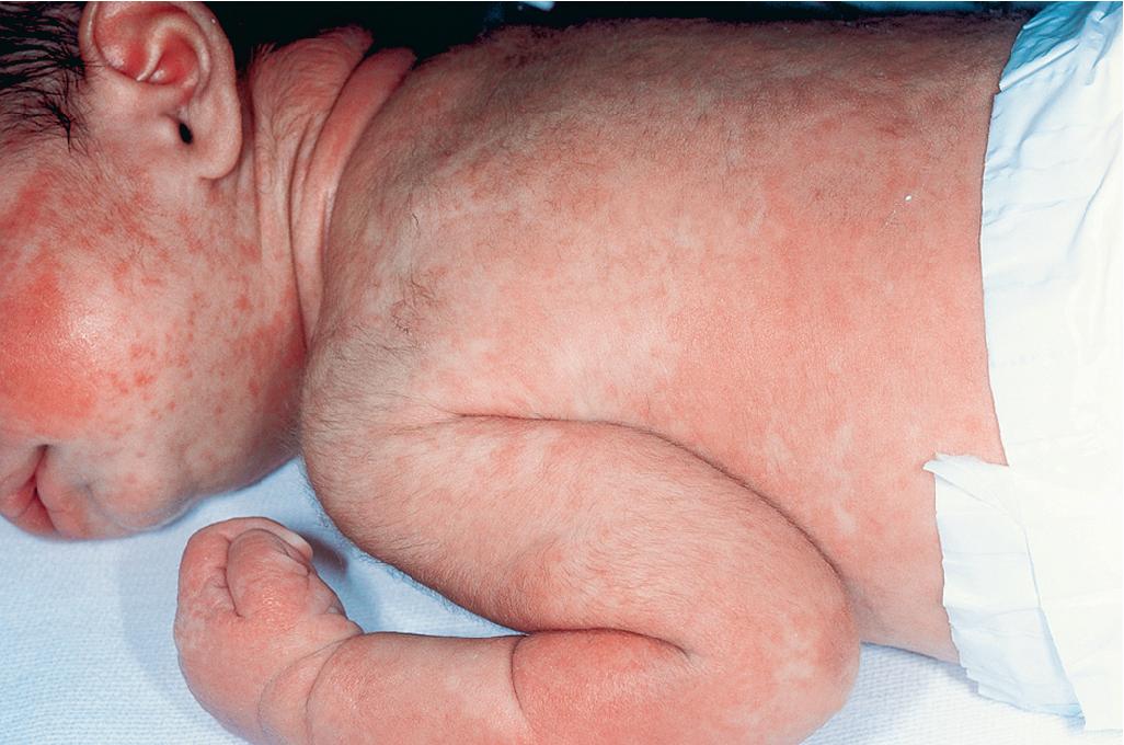 Fig. 25.5, Acute graft-versus-host disease. Almost confluent eruption of erythematous macules and papules in an immunodeficient neonate treated with extracorporeal membrane oxygenation (ECMO) and transfusion of nonirradiated blood.