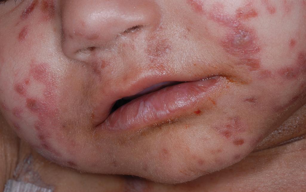 Fig. 25.7, Chronic graft-versus-host disease (GVHD), lichenoid. After bone marrow transplantation, this boy had acute GVHD and subsequently developed violaceous lichenoid papules of the face, trunk, and extremities. Note the white plaque of lichen planus on the lower lip.