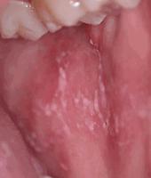 Fig. 25.8, Chronic graft-versus-host disease (GVHD), lichenoid. Note the white flat-topped papules on the buccal mucosa of this girl with early chronic GVHD.