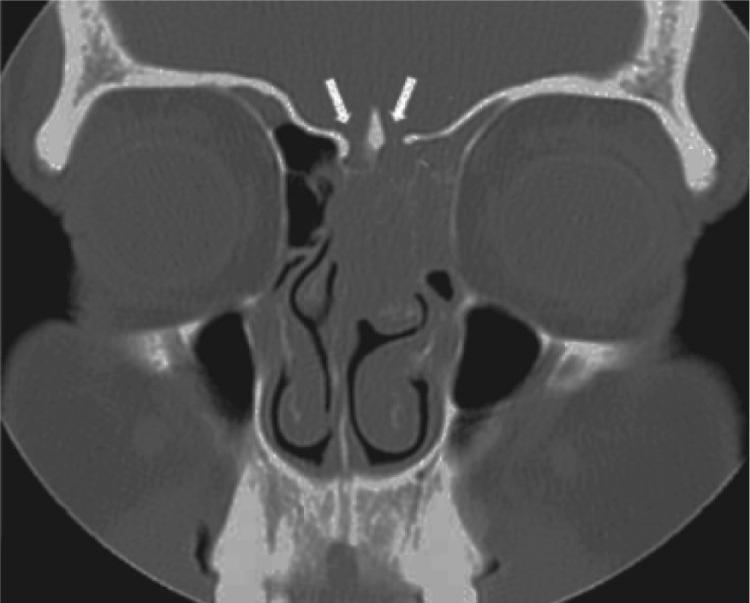 Figure 6.4, A coronal computed tomography scan (bone algorithm) showing early erosion of the cribriform plate ( white arrows ) from an esthesioneuroblastoma of the nasal cavity.