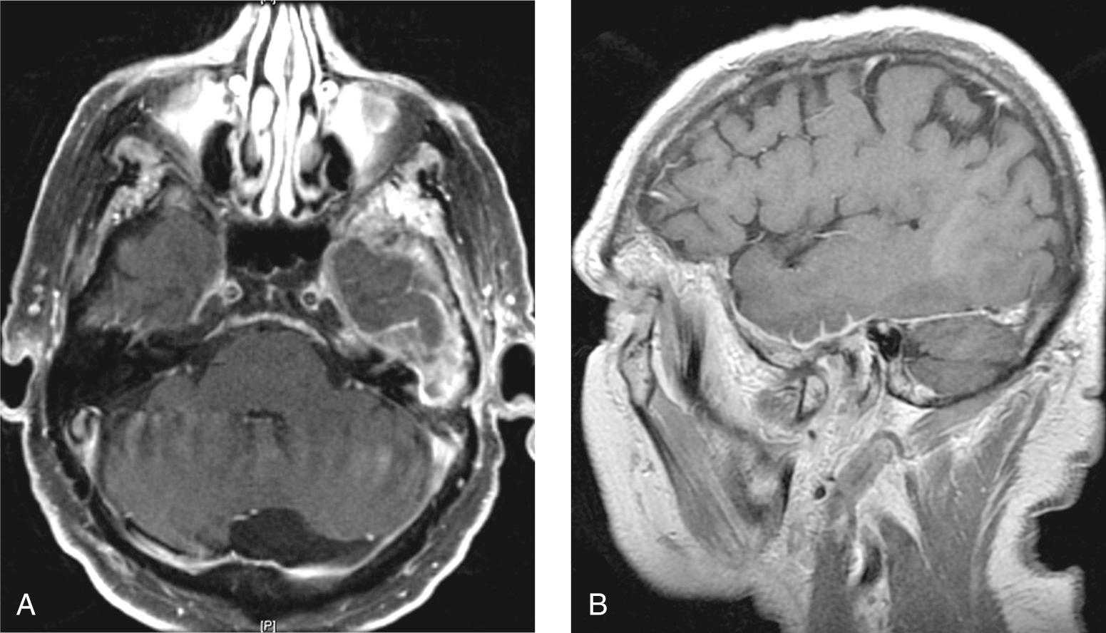 Figure 6.14, Postcontrast axial ( A ) and T1-weighted ( B ) magnetic resonance imaging scans showing leptomeningeal spread along the temporal lobe sulci in a patient with a squamous cell carcinoma of the left temporal bone.