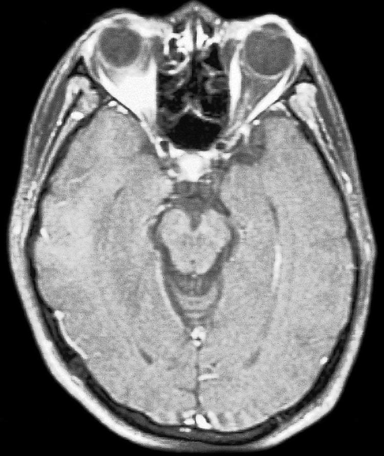 Figure 6.19, An axial view of a computed tomography scan at the level of the optic canal.