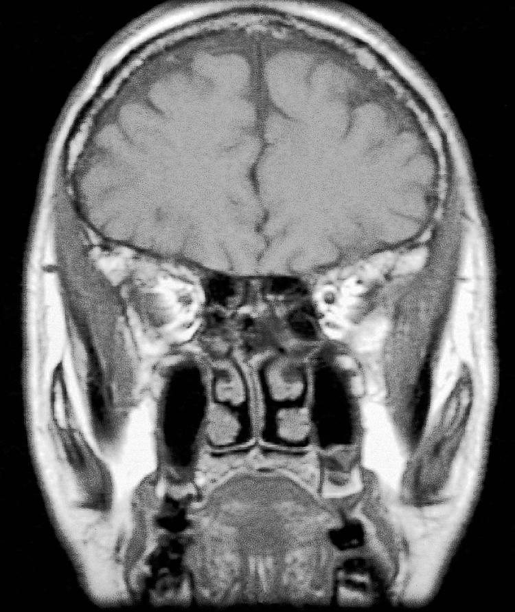 Figure 6.20, A coronal view of a computed tomography scan at the level of the optic foramen.