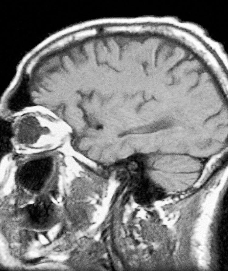 Figure 6.21, A sagittal view of a computed tomography scan at the level of the optic canal.