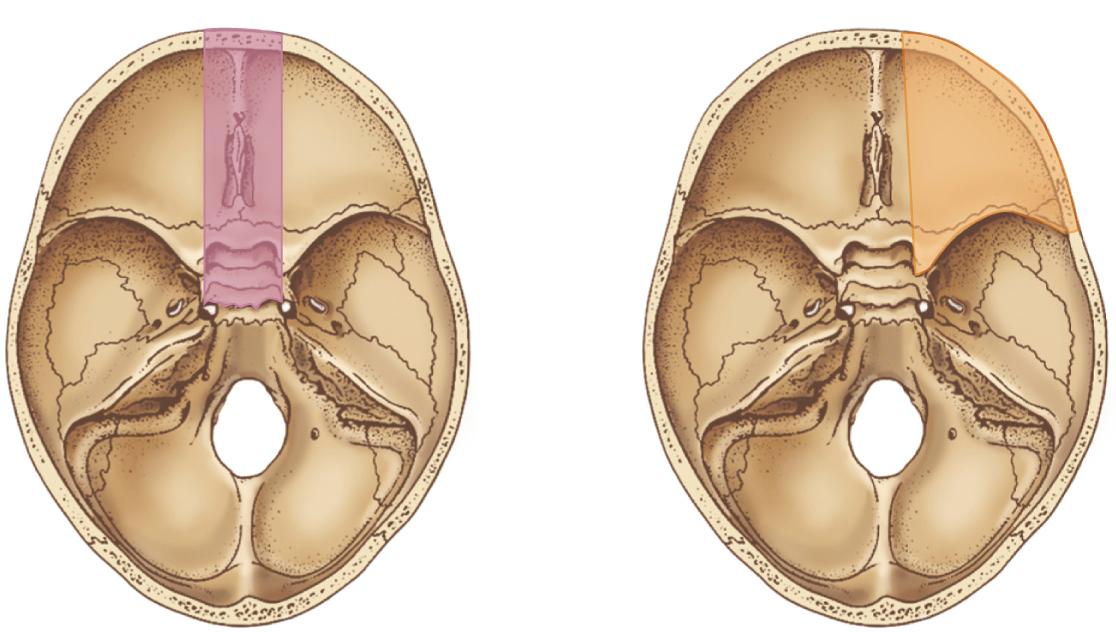 Figure 6.23, Anterior fossa cribriform plate region ( left ); anterior fossa orbit region ( right ) .