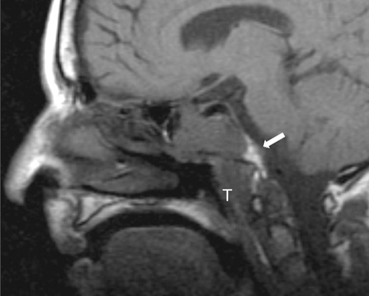 Figure 6.5, A sagittal T1-weighted magnetic resonance imaging scan showing replacement of the fatty marrow ( white arrow ) of the clivus by a sinus carcinoma ( T ).