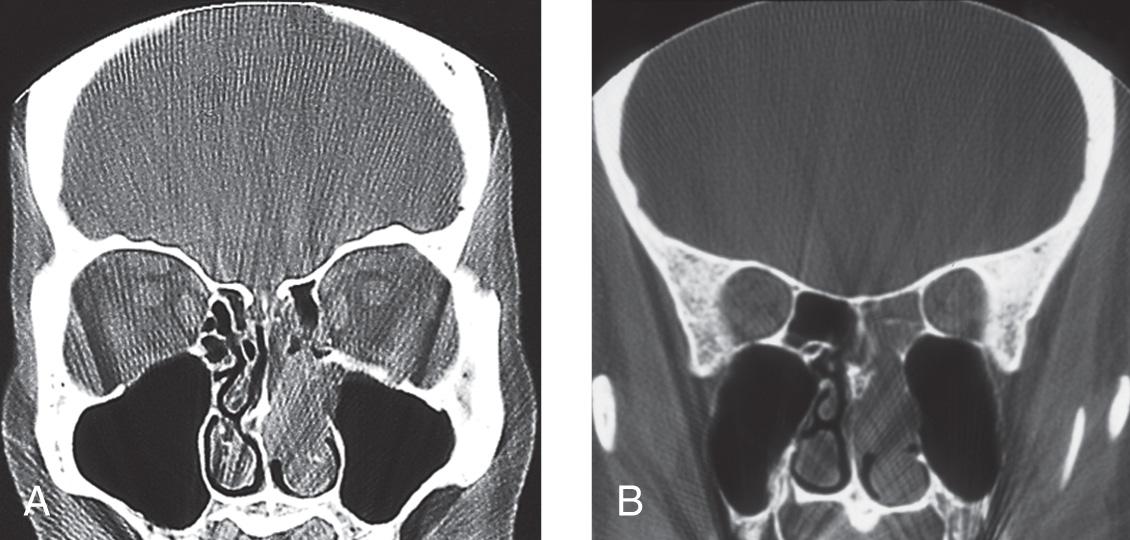 Figure 6.27, Coronal views of a computed tomography scan. A , Through cribriform plate. B , Through sphenoid sinus.