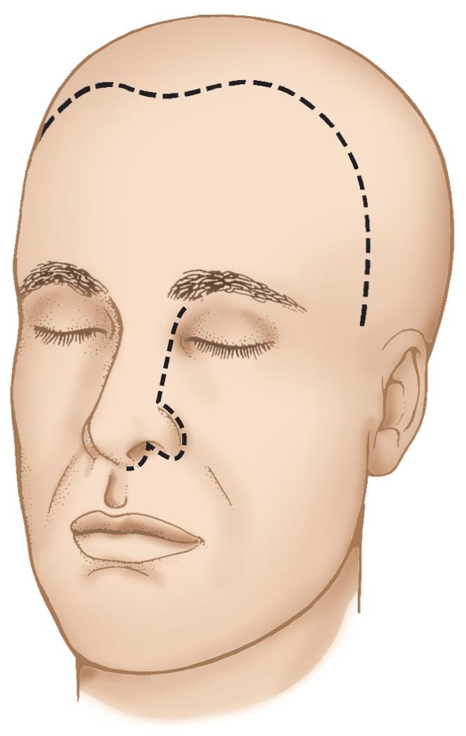 Figure 6.33, The proposed lines of incisions.