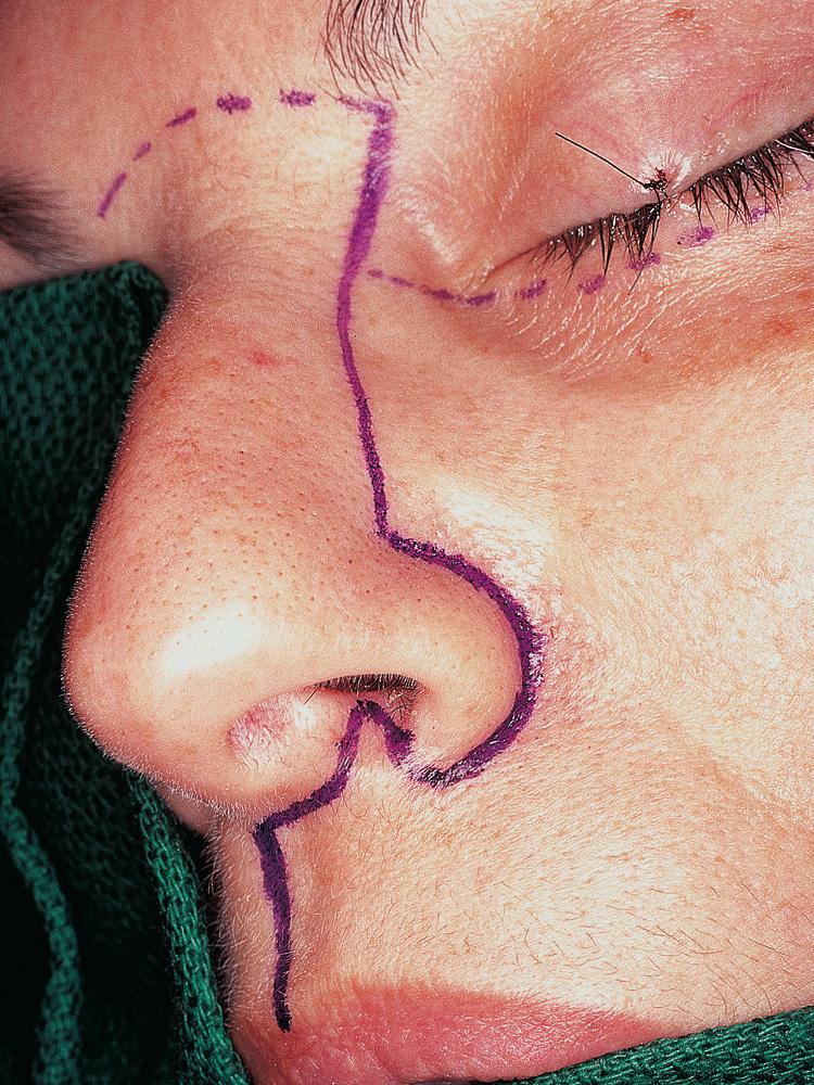 Figure 6.35, The facial exposure is usually obtained through a modified Weber-Ferguson incision, respecting the nasal subunits.