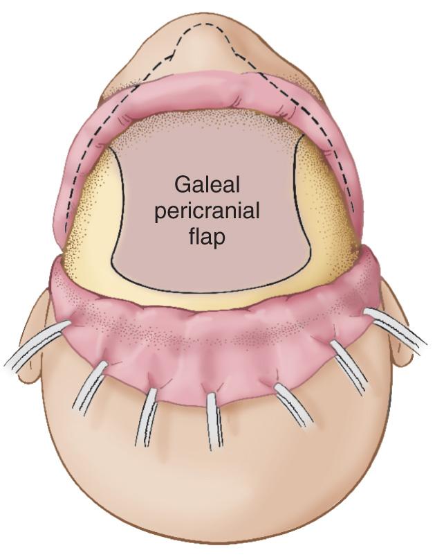 Figure 6.38, The proposed line of incision (U-shaped) in the pericranium for the elevation of a pedicled galeal-pericranial flap for subsequent use during repair of the skull base.