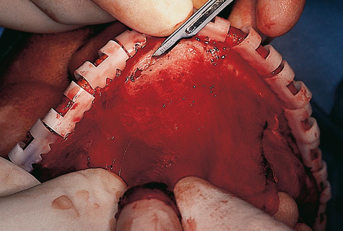 Figure 6.39, Elevation of the galeal pericranial flap requires careful sharp dissection with a scalpel between the subcutaneous tissue and the galea.