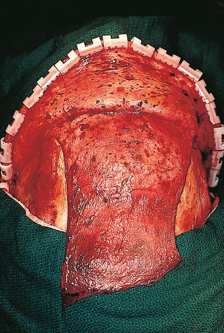 Figure 6.40, The galeal pericranial flap is a robust flap of sufficient length to allow for reconstruction of the skull base defect.