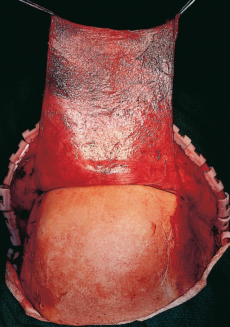 Figure 6.41, Complete elevation of the flap over the calvarium exposes the underlying frontal bone.