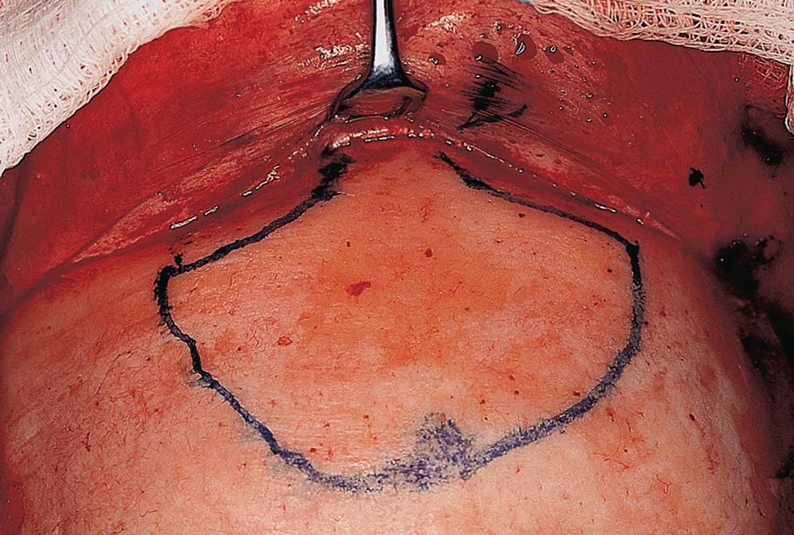Figure 6.42, A retractor placed in the center of the field shows the exposed upper part of the nasal bones and the supraorbital ridges bilaterally.