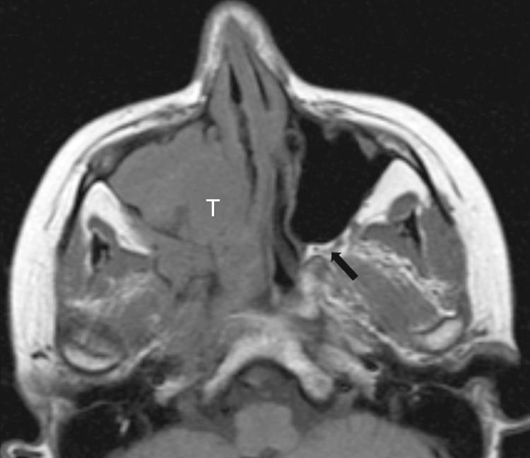 Figure 6.7, A precontrast T1-weighted magnetic resonance imaging (MRI) scan showing invasion of the right pterygopalatine fossa by a right maxillary sinus carcinoma (T). Note the normal appearance of the fat-filled opposite pterygopalatine fossa ( black arrow ) .