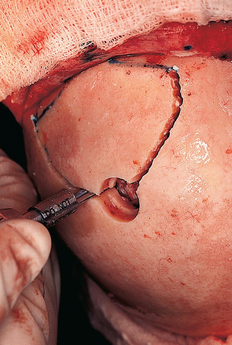 Figure 6.45, A circumferential bone cut is made at the proposed line of the craniotomy.