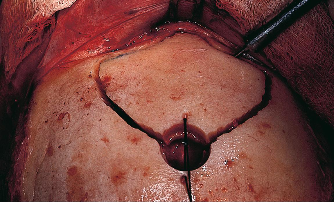 Figure 6.46, Inferiorly only, the anterior wall of the frontal sinus is cut with the side-cutting saw to complete the craniotomy.