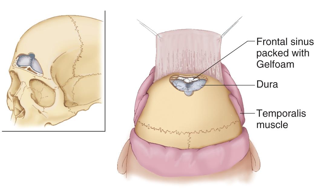 Figure 6.47, Removal of the bone flap exposes the dura over the frontal lobes as well as the frontal sinus.