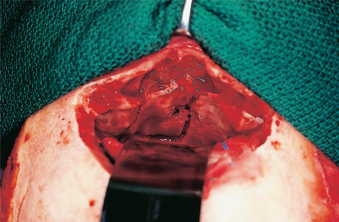 Figure 6.48, The mucosa of the frontal sinus is completely curetted out, and its posterior wall is removed to cranialize the sinus.