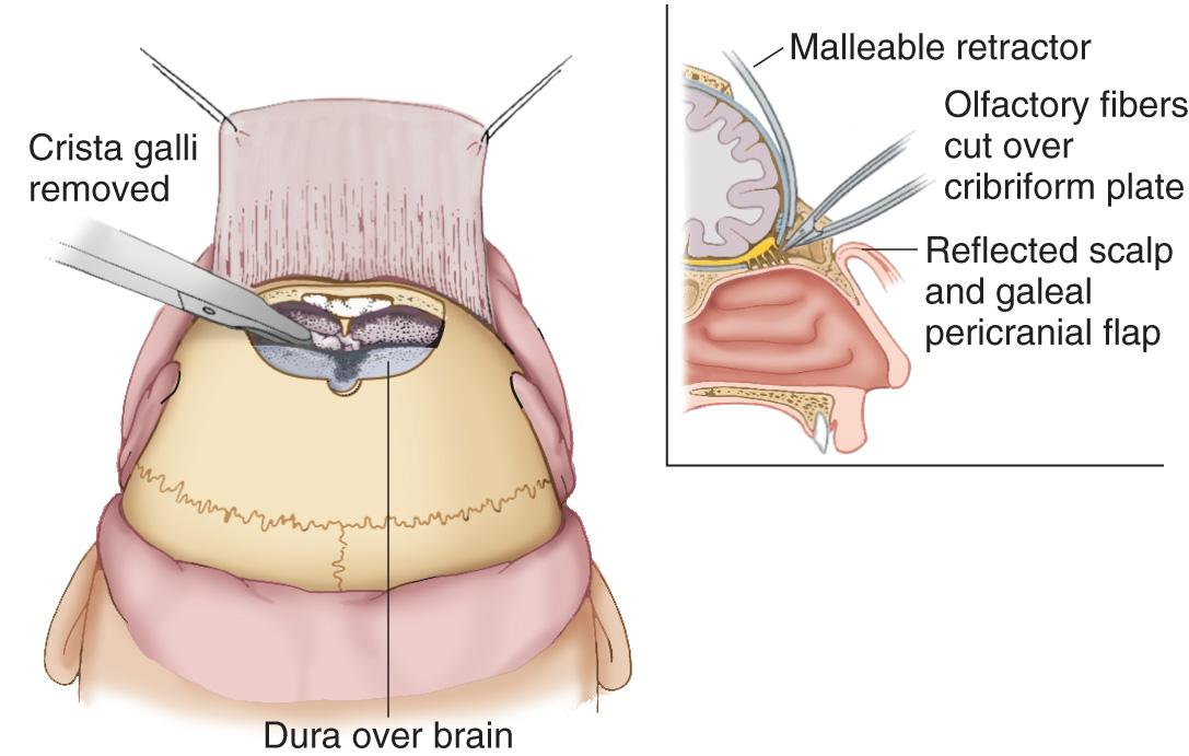 Figure 6.49, Attention is now directed to the elevation of the dura from the floor of the anterior cranial fossa.