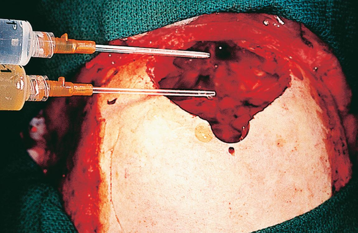 Figure 6.52, Fibrin glue is used to attain an additional protective layer of water-tight closure over the sutured dural sleeves.