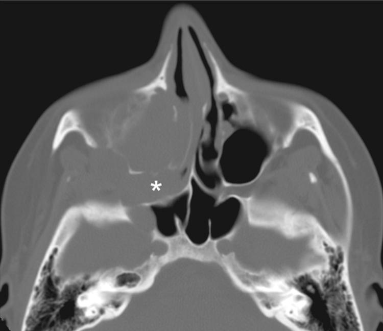 Figure 6.8, An axial computed tomography scan (bone algorithm) showing widening of the right pterygo palatine fossa ( * ) compared to left.