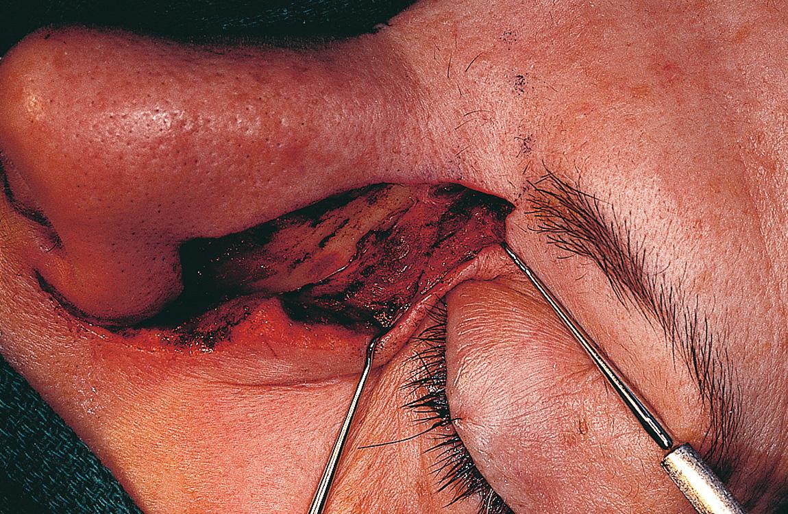 Figure 6.56, The attachment of the medial canthal ligament is identified.