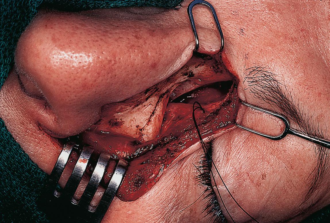 Figure 6.57, The medial canthal ligament is detached and retracted with a 4-0 Nurolon suture that will be used subsequently for its fixation to the nasal bone during closure.