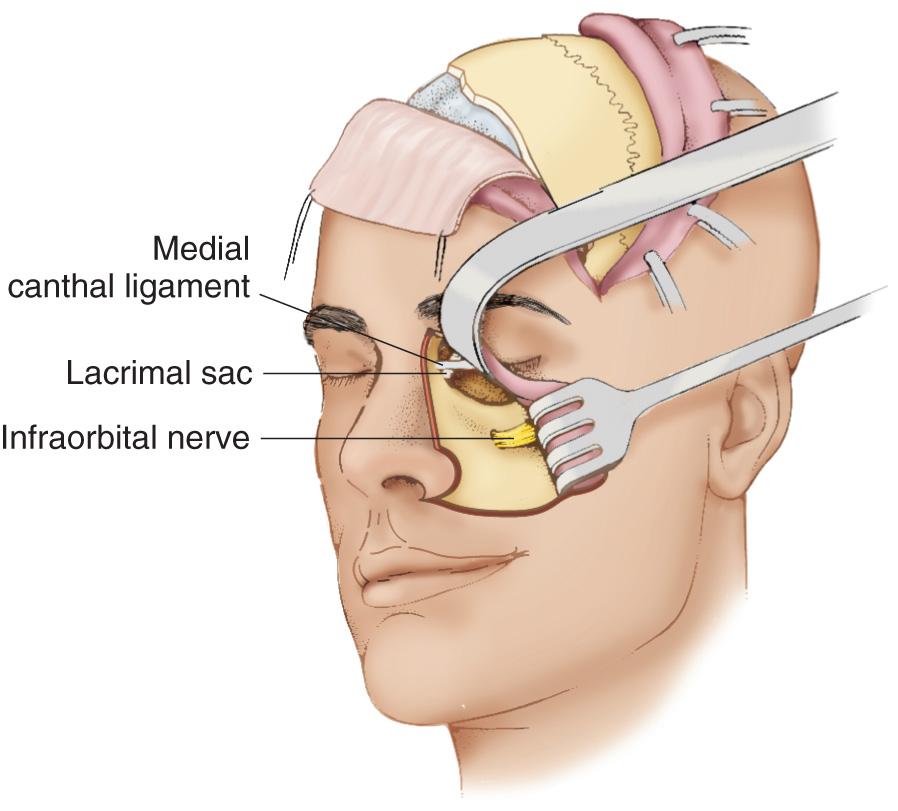 Figure 6.59, The cheek flap is elevated directly over the anterior bony wall of the maxilla, carefully preserving the intraorbital nerve as it exits from the infraorbital foramen.