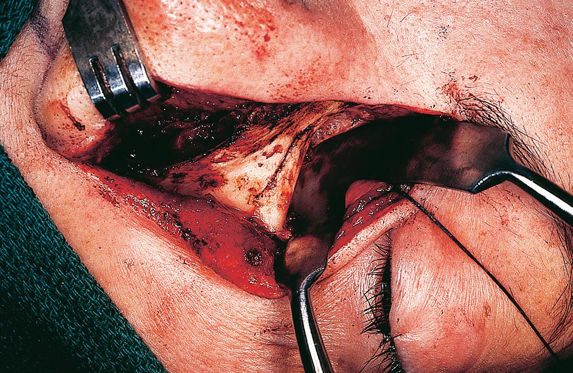 Figure 6.60, The mucosa of the naval cavity is now incised through its lateral wall at the vestibule along the anteromedial wall of the maxilla.