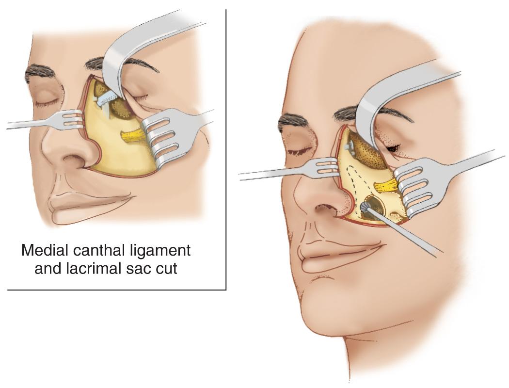 Figure 6.61, The anterior wall of the maxillary antrum is opened with use of a high-speed drill and a burr.