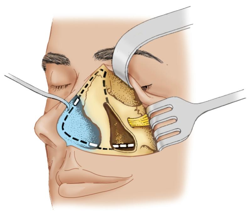 Figure 6.63, Bone cuts are now made through the nasal process of the maxilla and through the lacrimal fossa and the anterior aspect of the lamina papyracea within the orbit on the left-hand side.