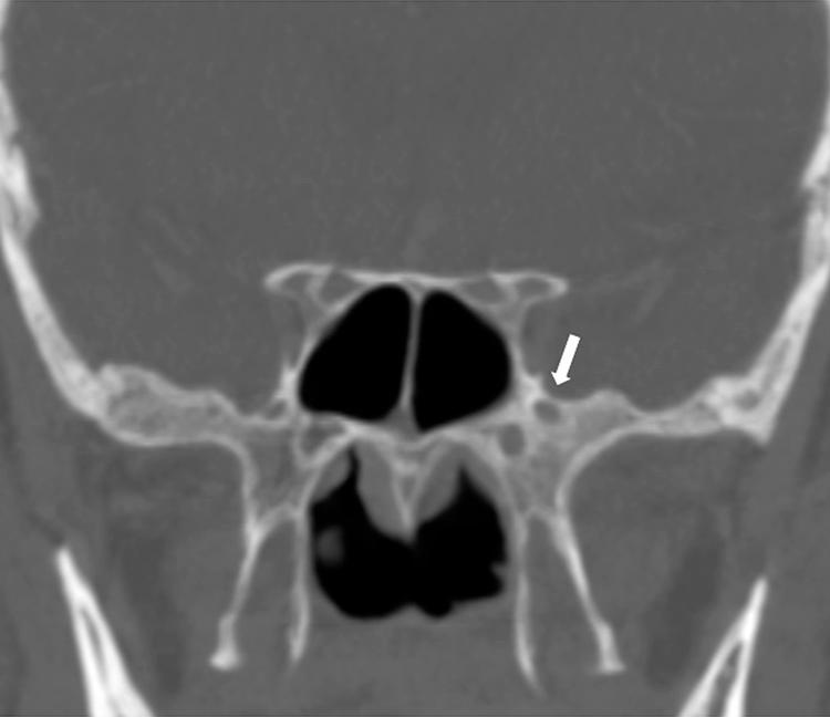 Figure 6.9, Coronal reconstruction of the bone algorithm of a computed tomography scan showing widening of the left foramen rotundum ( arrow ) by perineural spread of a maxillary sinus carcinoma. Note that the integrity of the bony walls of the foramen is preserved.