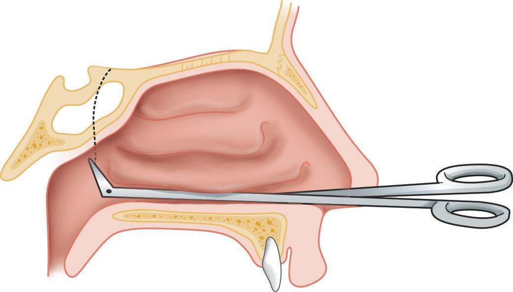 Figure 6.64, Right-angled scissors are used to cut through the posterior aspect of the lateral wall of the nasal cavity.