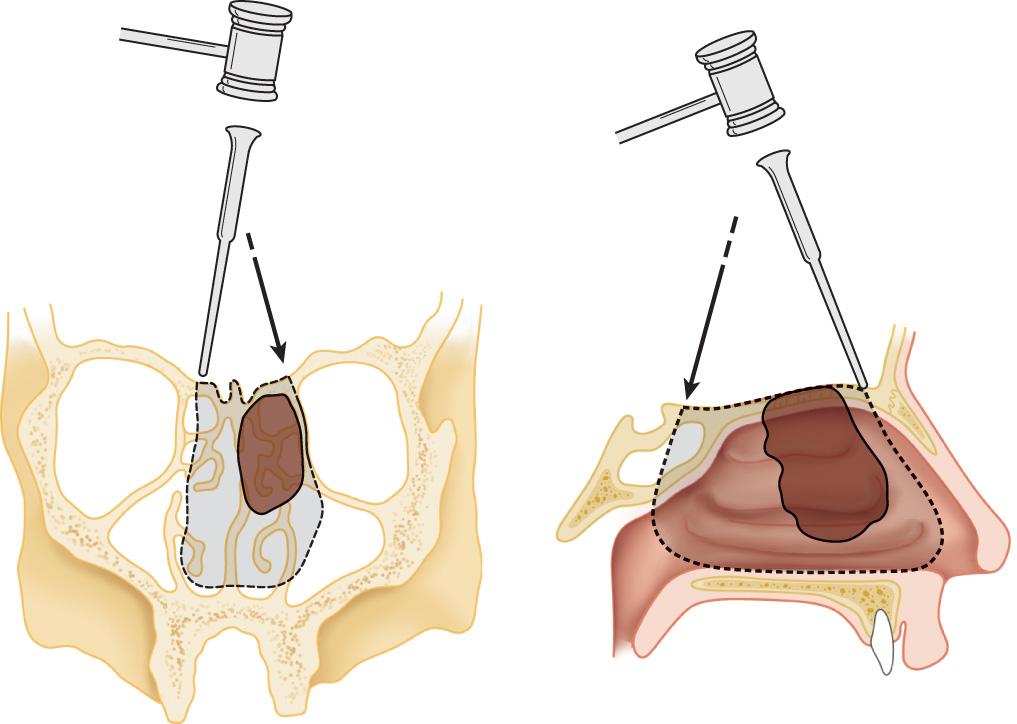 Figure 6.65, The specimen is removed under digital and visual guidance through the cranial and facial exposures.