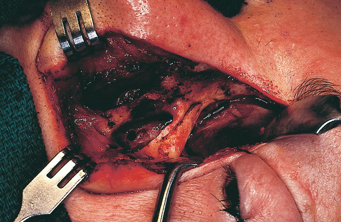 Figure 6.66, The surgical defect seen from the facial aspect.