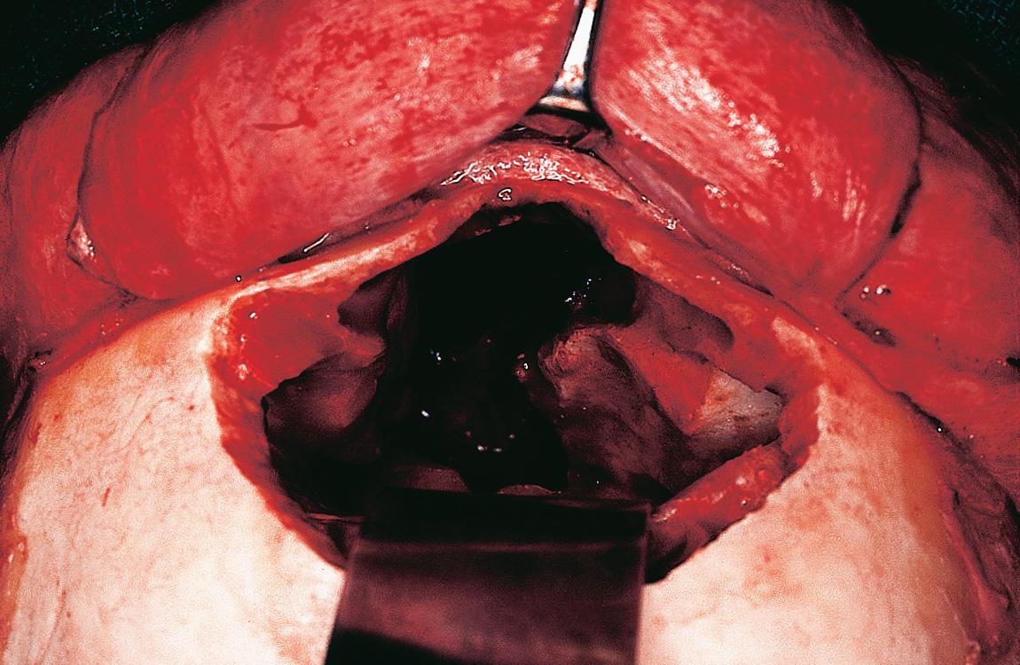 Figure 6.67, The surgical defect seen from the cranial aspect.