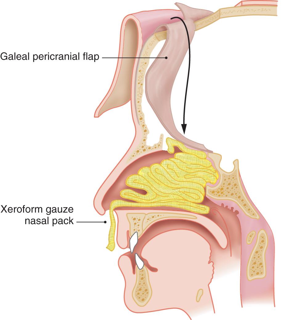 Figure 6.68, A diagrammatic representation of how the galeal pericranial pedicled flap is swung down to cover the bony defect in the skull base.