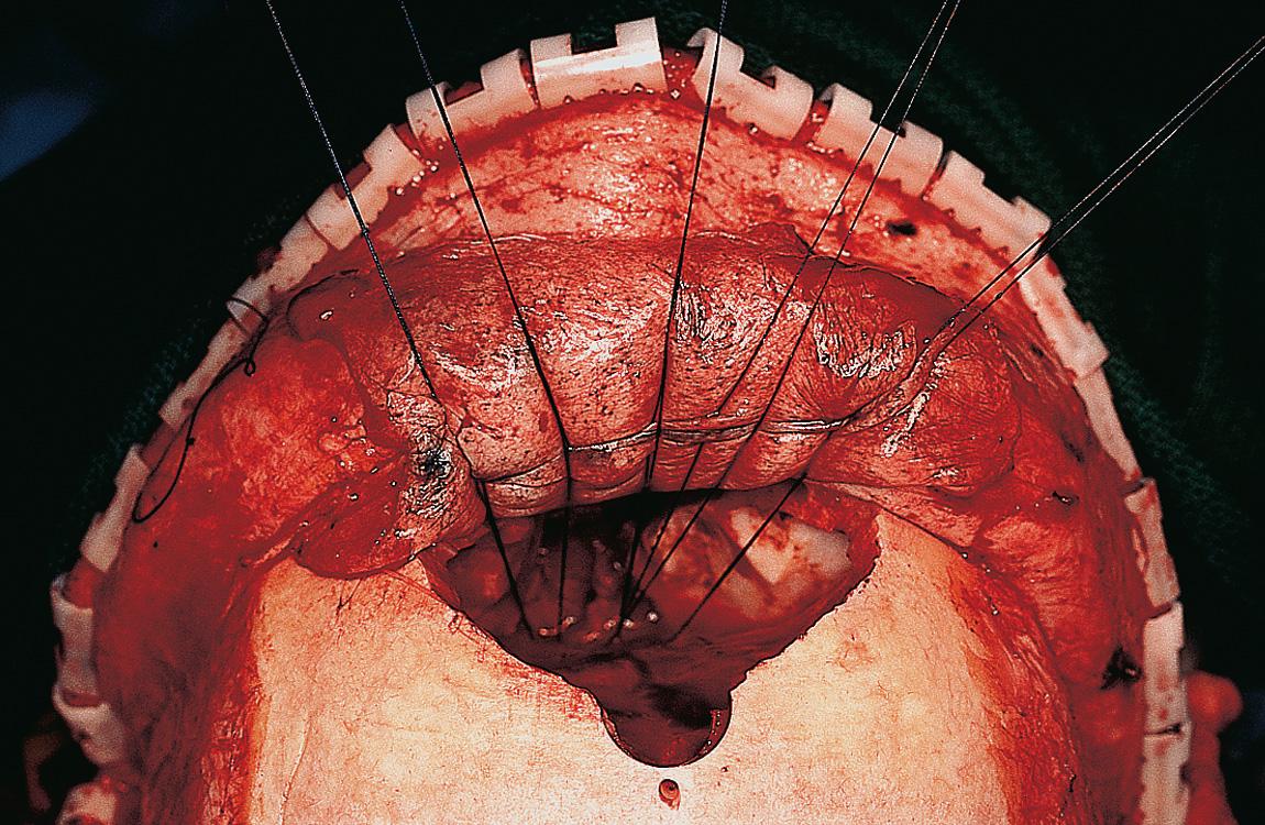 Figure 6.69, Several interrupted sutures are taken between the galeal pericranial flap and the drill holes through the floor of the anterior cranial fossa.