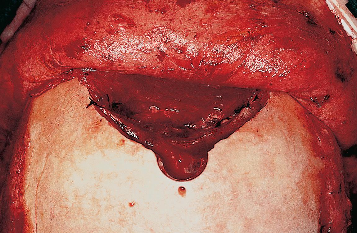 Figure 6.70, The galeal pericranial flap is sutured to the bony skull base, providing complete closure of the bony defect in the skull.