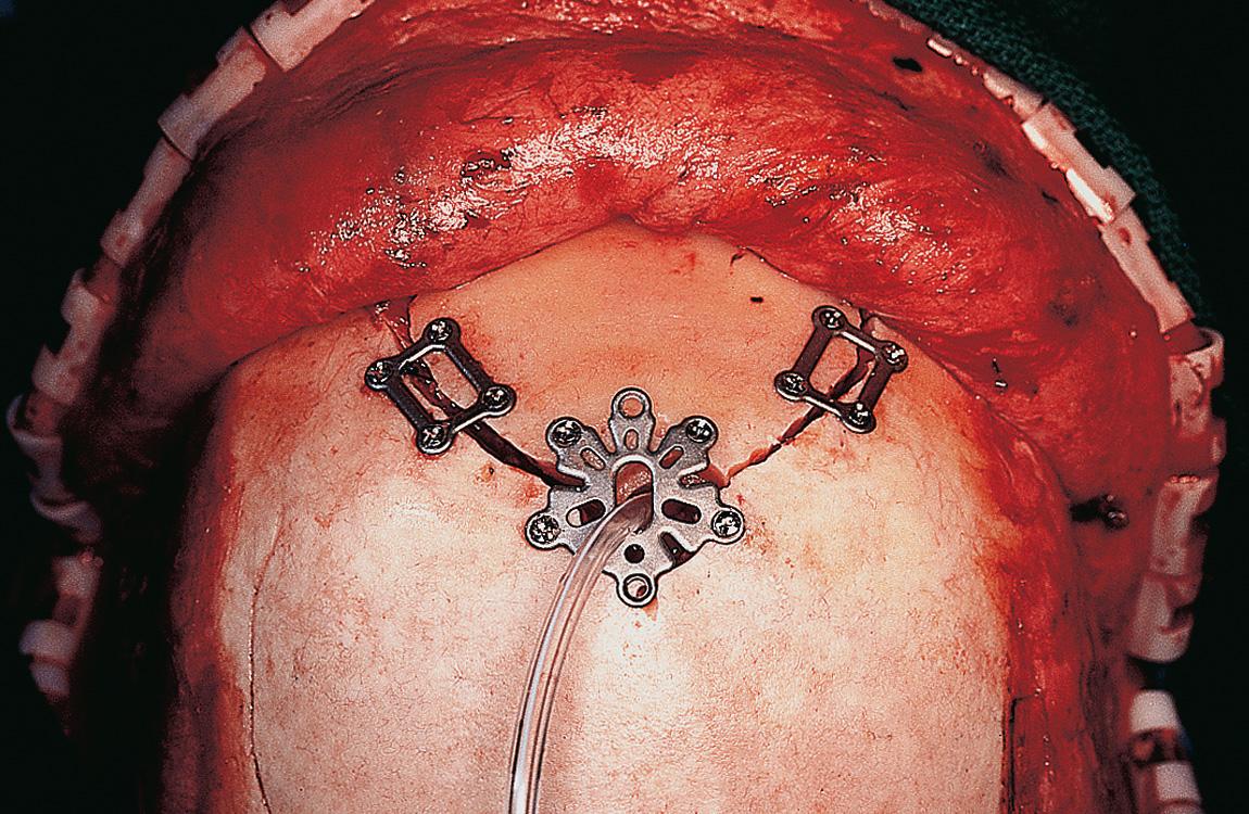 Figure 6.71, The craniotomy is closed with appropriate miniplates. A suction drain is placed through the burr hole in the extradural space, deep to the bone flap.