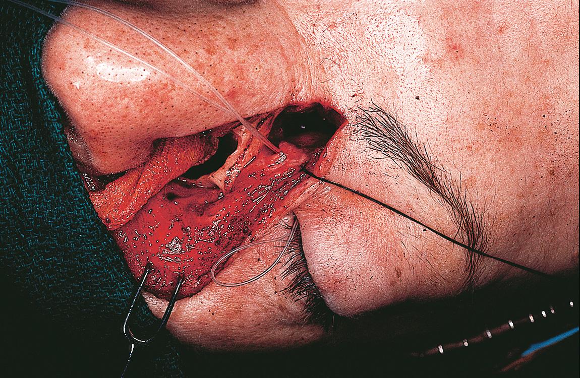 Figure 6.72, The nasolacrimal duct is cannulated with a Silastic stent and Xeroform roller gauze is packed into the nasal cavity.