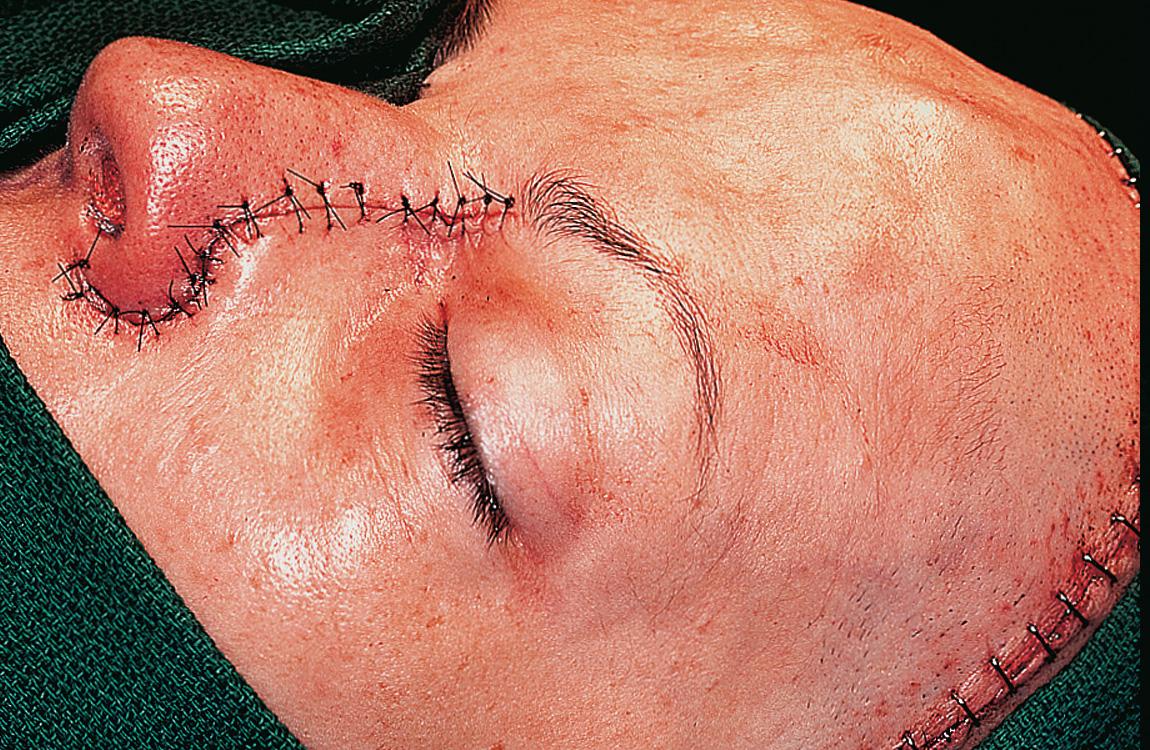 Figure 6.73, The facial incision is closed in the usual fashion.