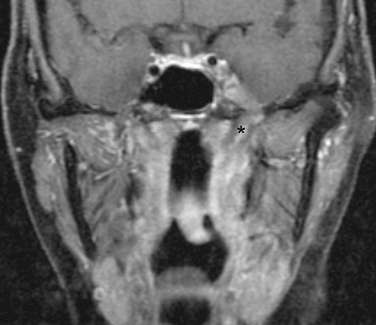 Figure 6.10, Perineural involvement of the left V3 seen as a thickened, enhancing nerve (*) on a contrast-enhanced T1-weighted magnetic resonance imaging scan.